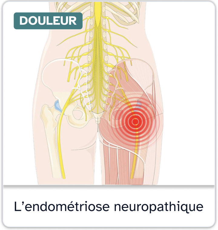 Fiche information endometriose douleur neuropathique