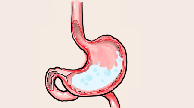 Gastroparésie