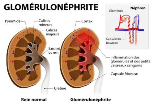 Glomerulonephrite