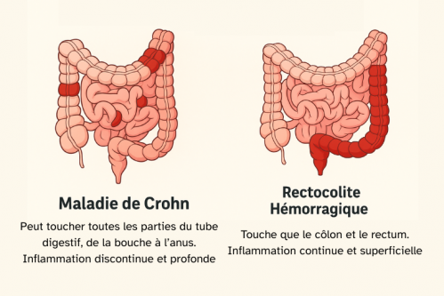 Maladie de crohn rectocolite hemorragique rch schema difference 2