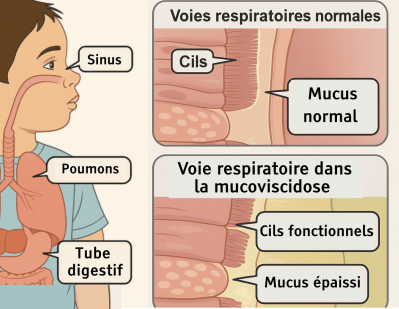 Schéma sur les mécanismes de la mucoviscidose