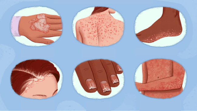 Psoriasis