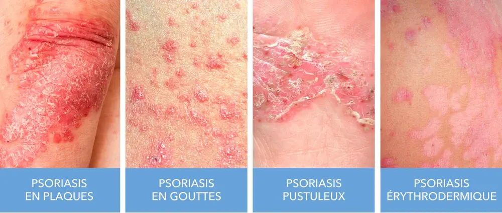 Photos des différents types de psoriasis
