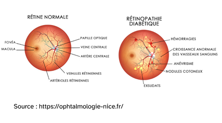 Retine normale vs diabetique