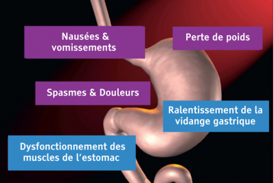 Schéma sur la gastroparésie et ses symptômes