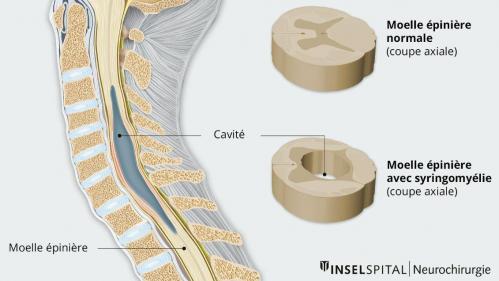 Syringomyelie 1