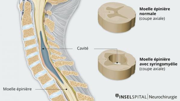 Syringomyelie 1