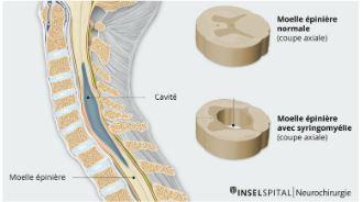 Syringomyelie
