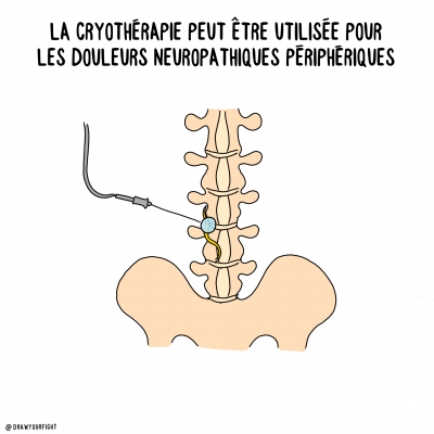 Traitement douleur chronique neuropathique cryotherapie